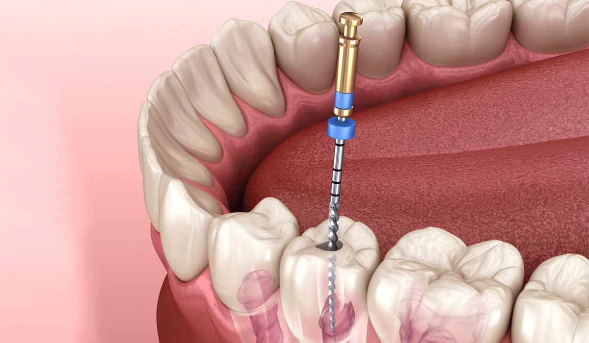 Root Canal Therapy