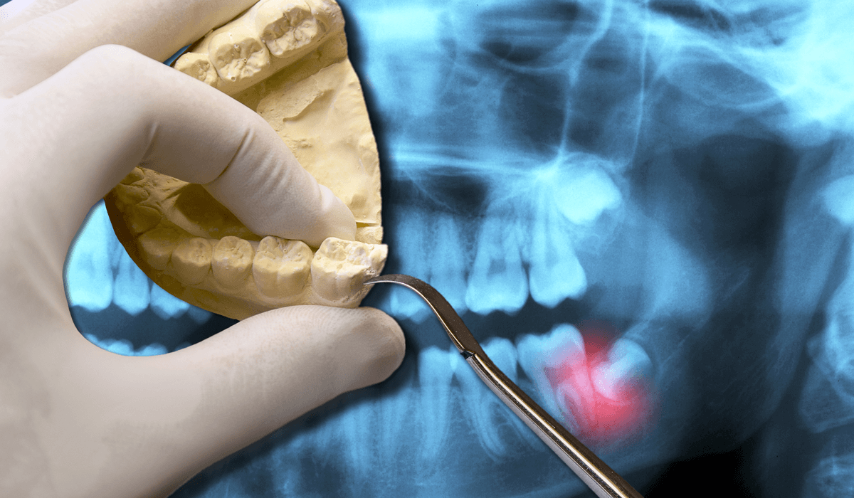 Wisdom Tooth Removal