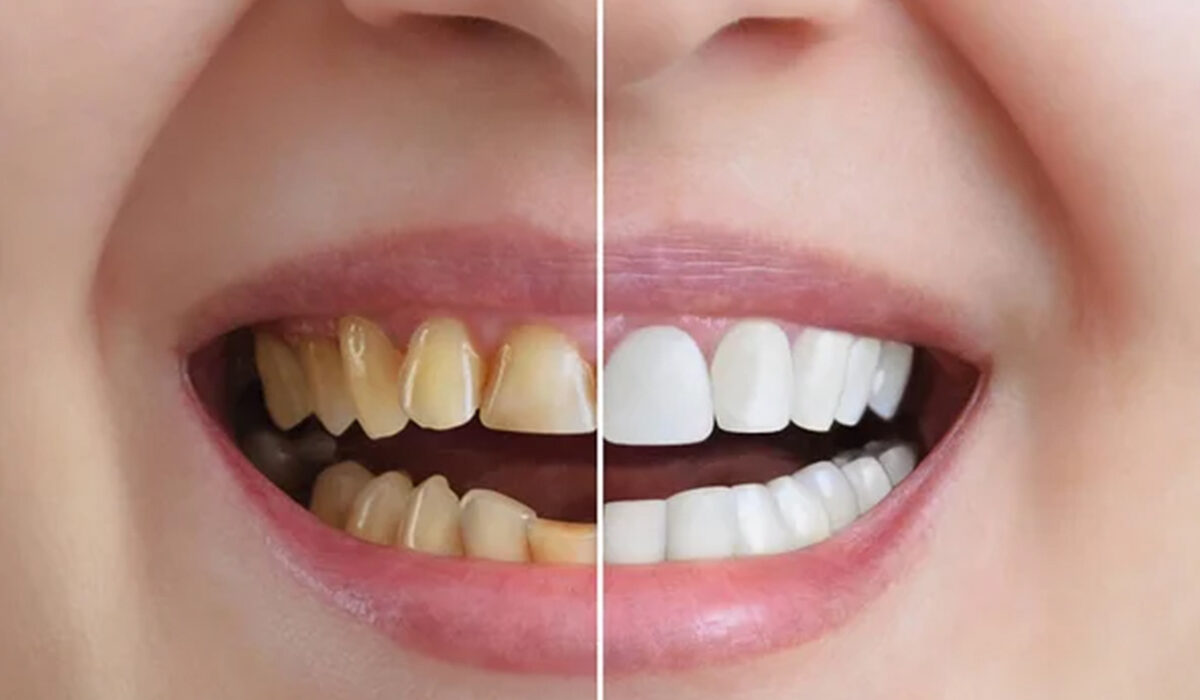 Smile Makeover